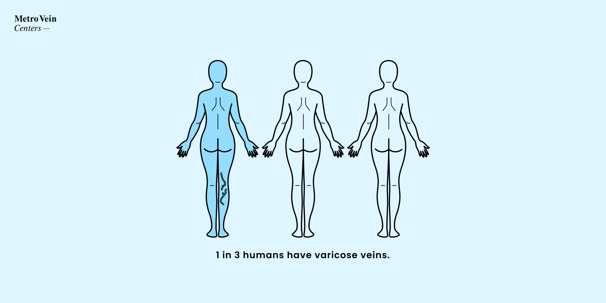 Infographic showing 1 in 3 people get varicose veins in their life