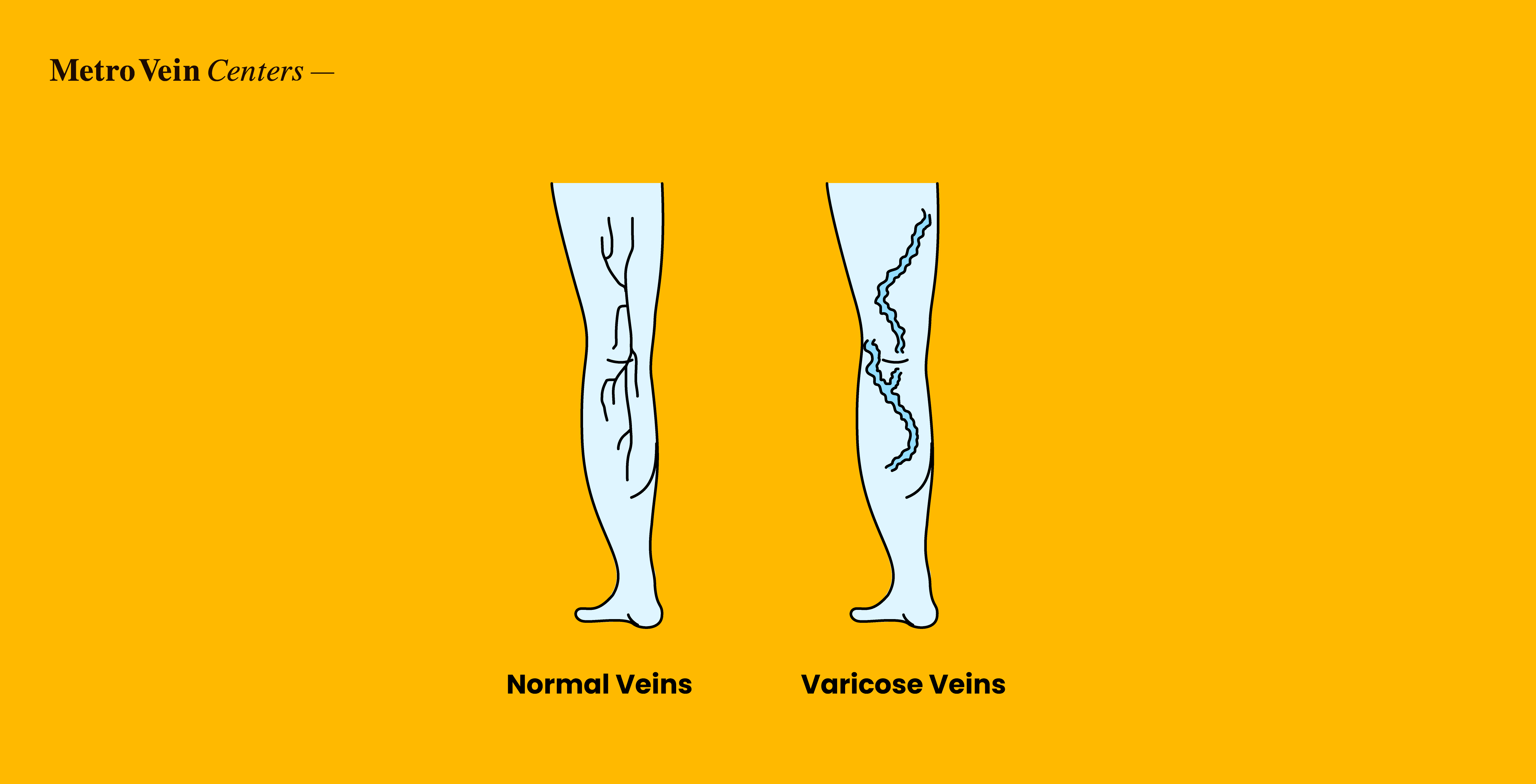 Explore how lymphedema and varicose veins are connected, what makes them different, shared risk factors, and when to seek expert vein specialist care.