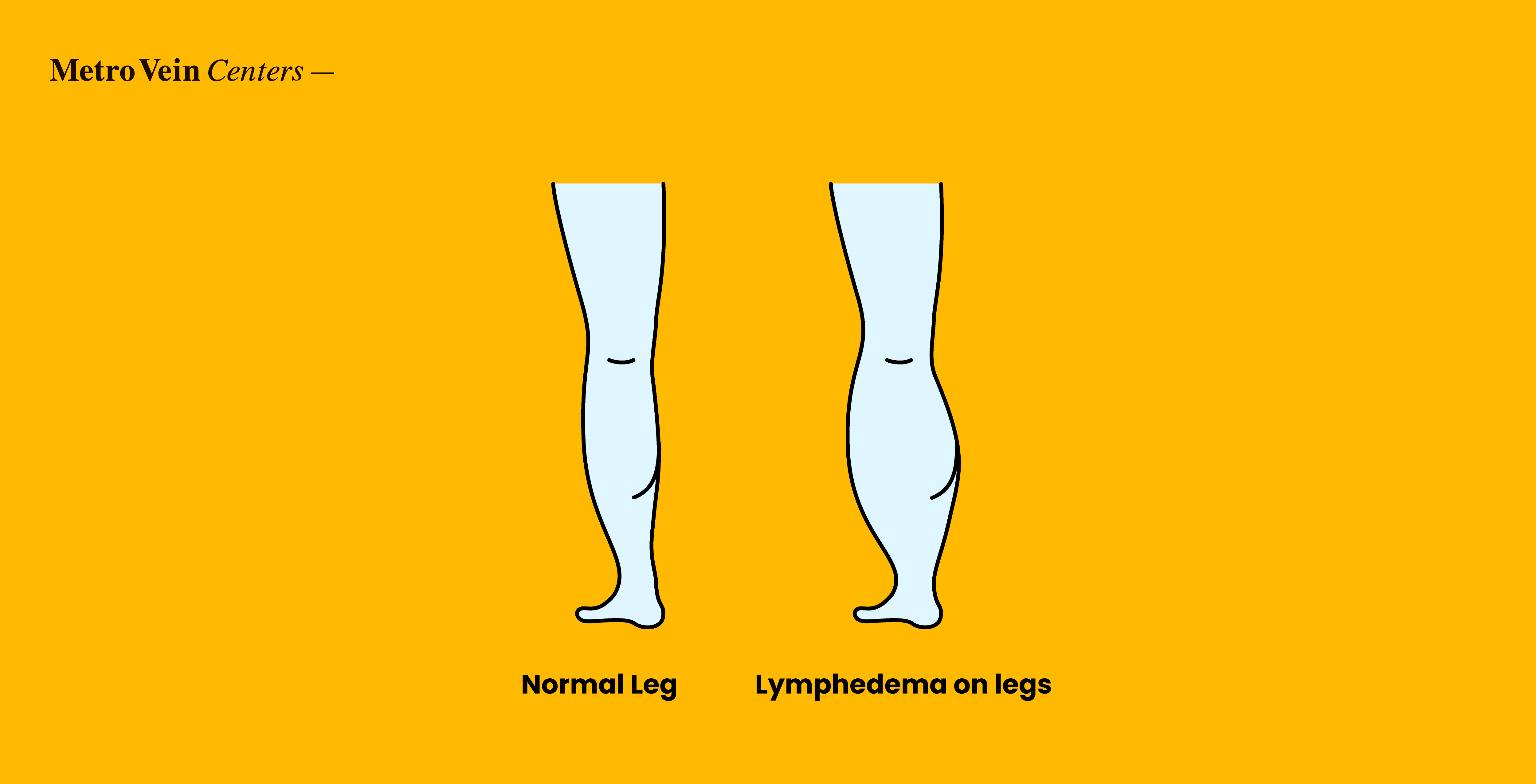 Explore how lymphedema and varicose veins are connected, what makes them different, shared risk factors, and when to seek expert vein specialist care.