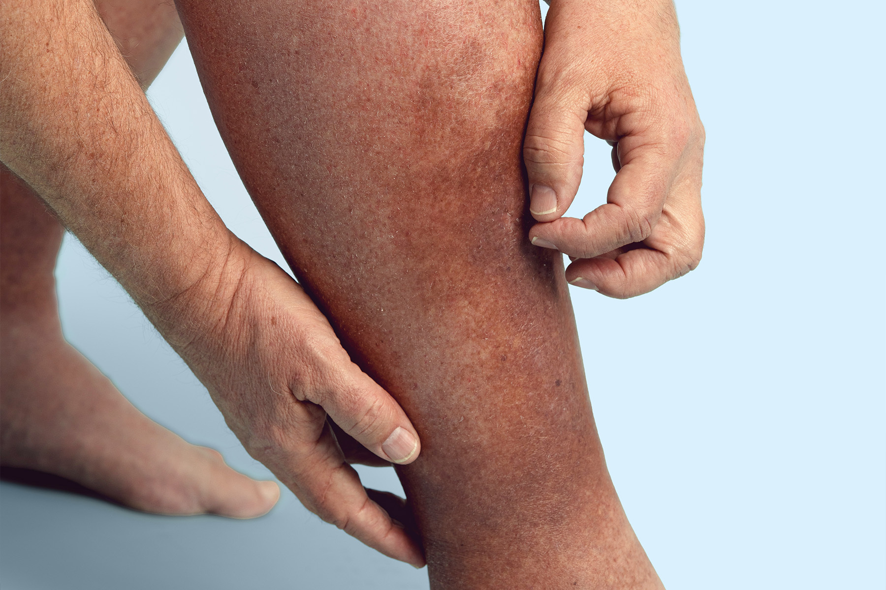 President Trump&rsquo;s chronic venous insufficiency (CVI) diagnosis explained: symptoms, causes, and modern treatments for this common, treatable vein disease.