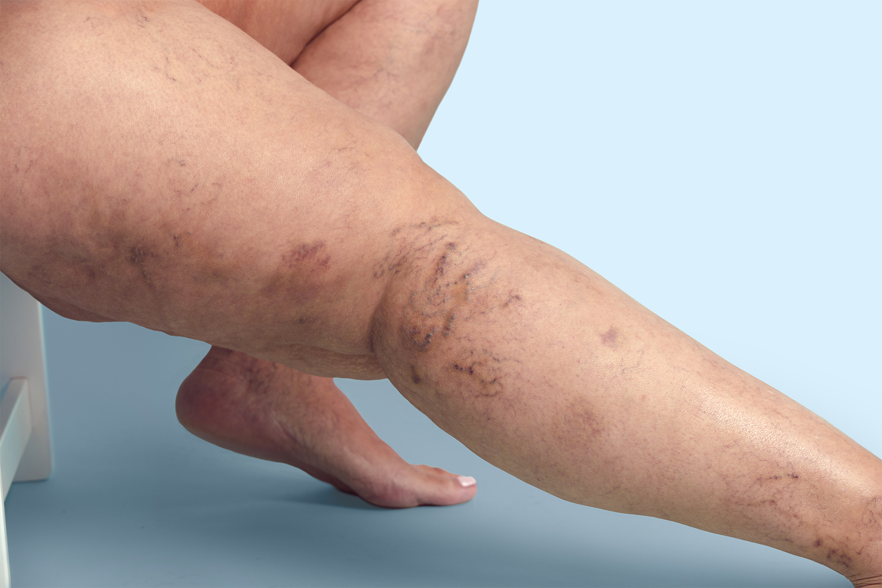 Compare top minimally invasive treatments for chronic venous insufficiency and leg swelling, including Varithena, VenaSeal, and Radiofrequency Ablation.