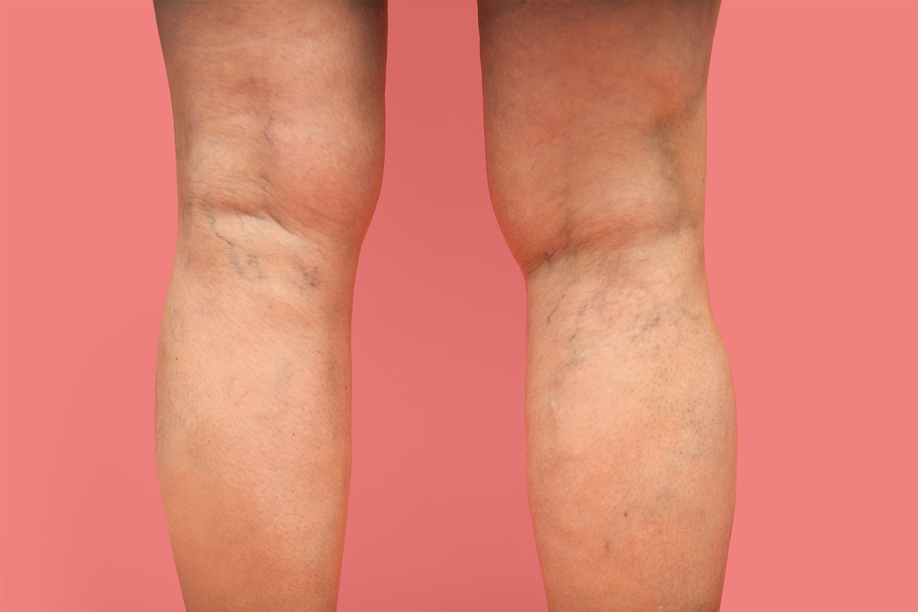 Vein health supports circulation, energy, and mobility. Prevent varicose veins, CVI, leg swelling, and heaviness with simple wellness habits.