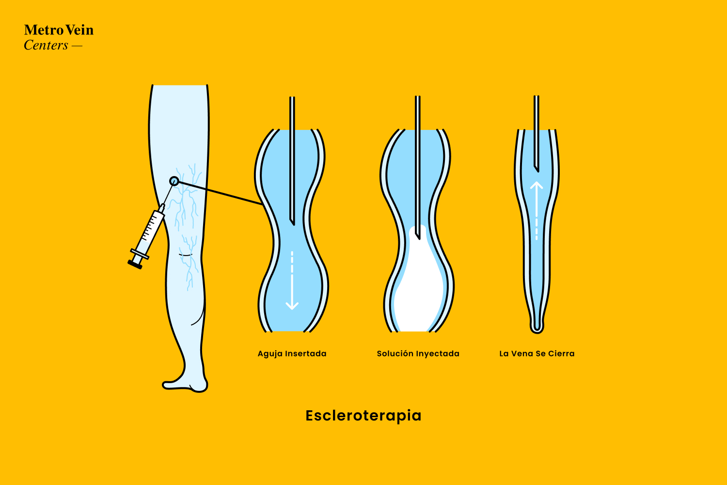 &iquest;Es la escleroterapia adecuada para tus venas? Descubre 4 cosas esenciales: duraci&oacute;n, efectos secundarios, recuperaci&oacute;n y resultados reales. &iexcl;Inf&oacute;rmate en Metro Vein Centers!