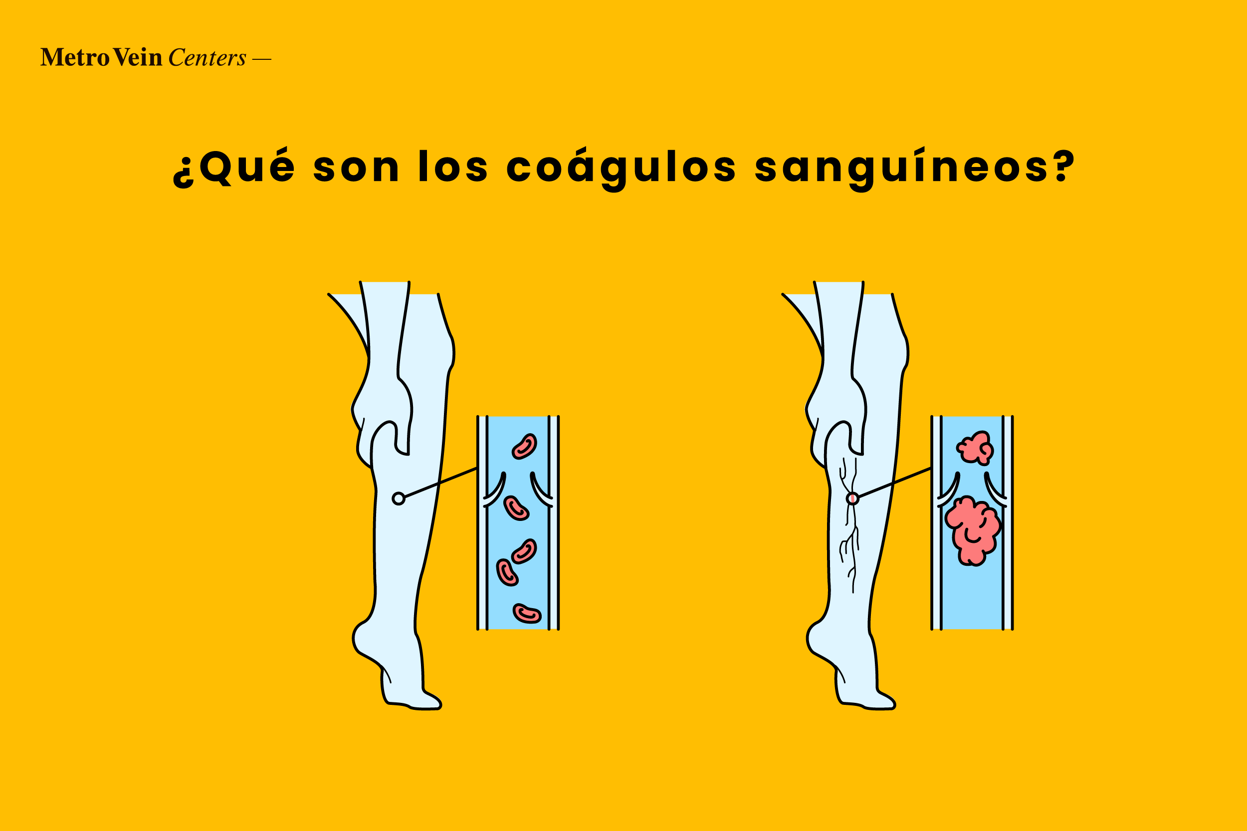 Aprende a identificar co&aacute;gulos de sangre en los tobillos, pies y piernas con im&aacute;genes detalladas. Descubre los s&iacute;ntomas, el diagn&oacute;stico y las opciones de tratamiento para unas piernas m&aacute;s seguras.