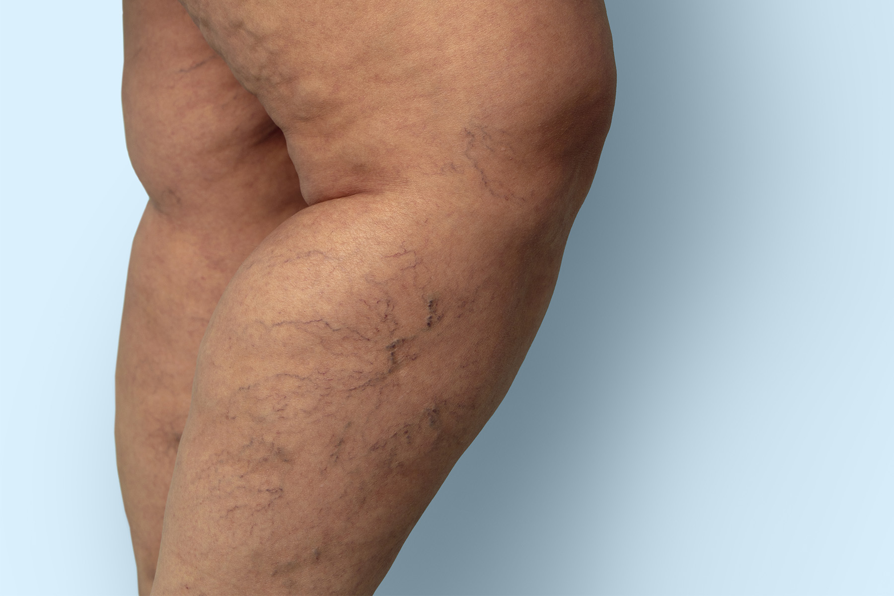 Descubra c&oacute;mo se relacionan el linfedema y las varices, en qu&eacute; se diferencian, qu&eacute; factores de riesgo comparten y cu&aacute;ndo consultar a un especialista en venas.