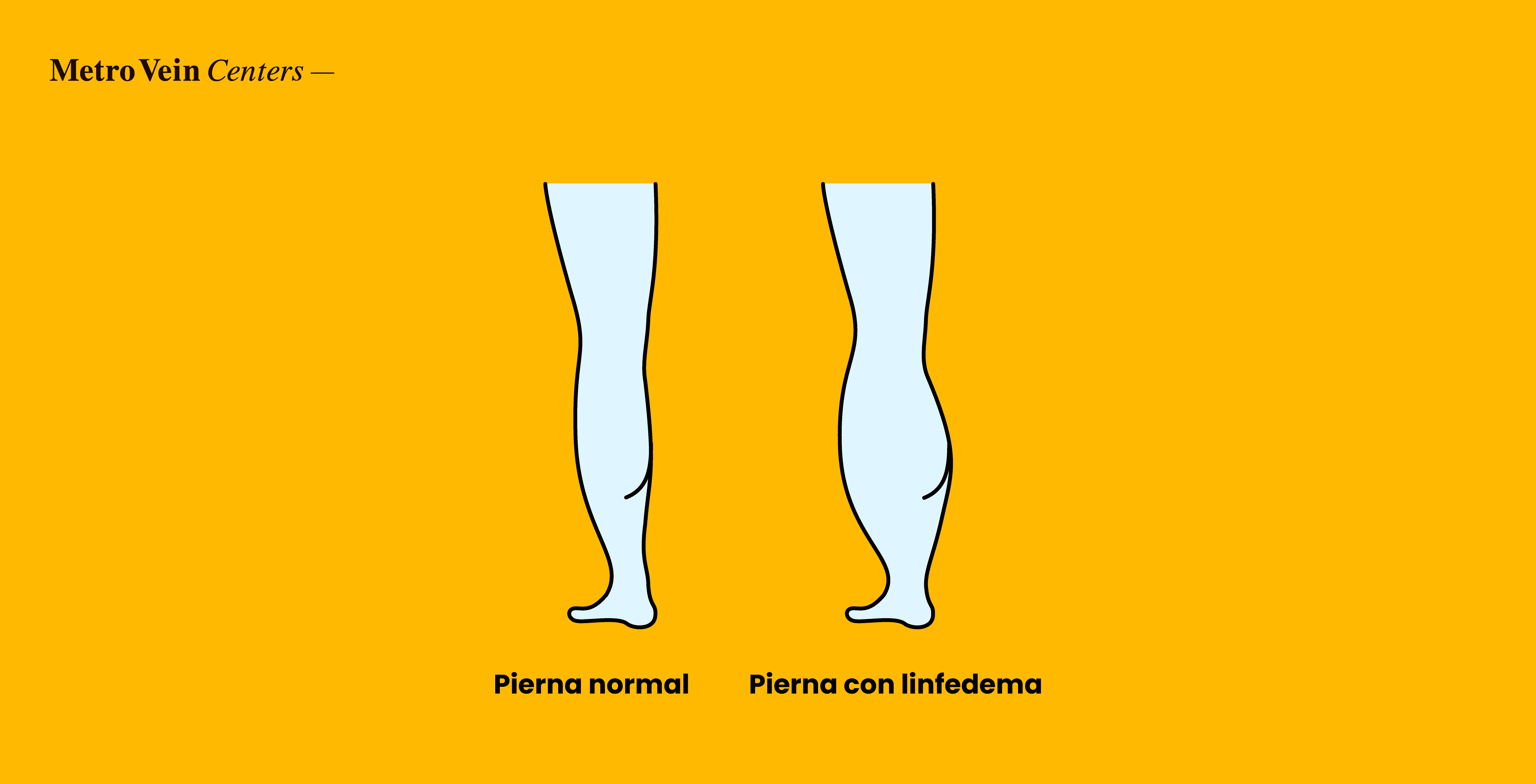 Descubra c&oacute;mo se relacionan el linfedema y las varices, en qu&eacute; se diferencian, qu&eacute; factores de riesgo comparten y cu&aacute;ndo consultar a un especialista en venas.