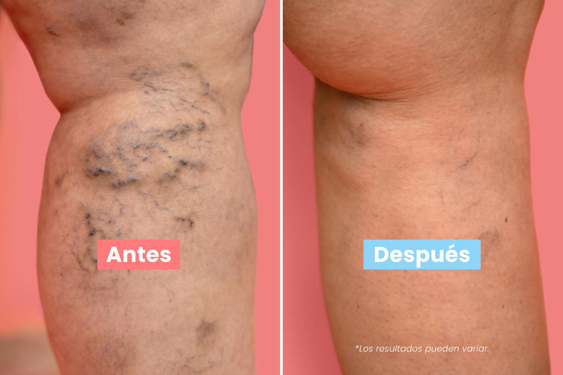 Mu&eacute;strale un poco de amor a tus piernas con simples consejos de cuidado venoso que mejoran la comodidad, la circulaci&oacute;n y la confianza. Las piernas saludables se sienten mejor.