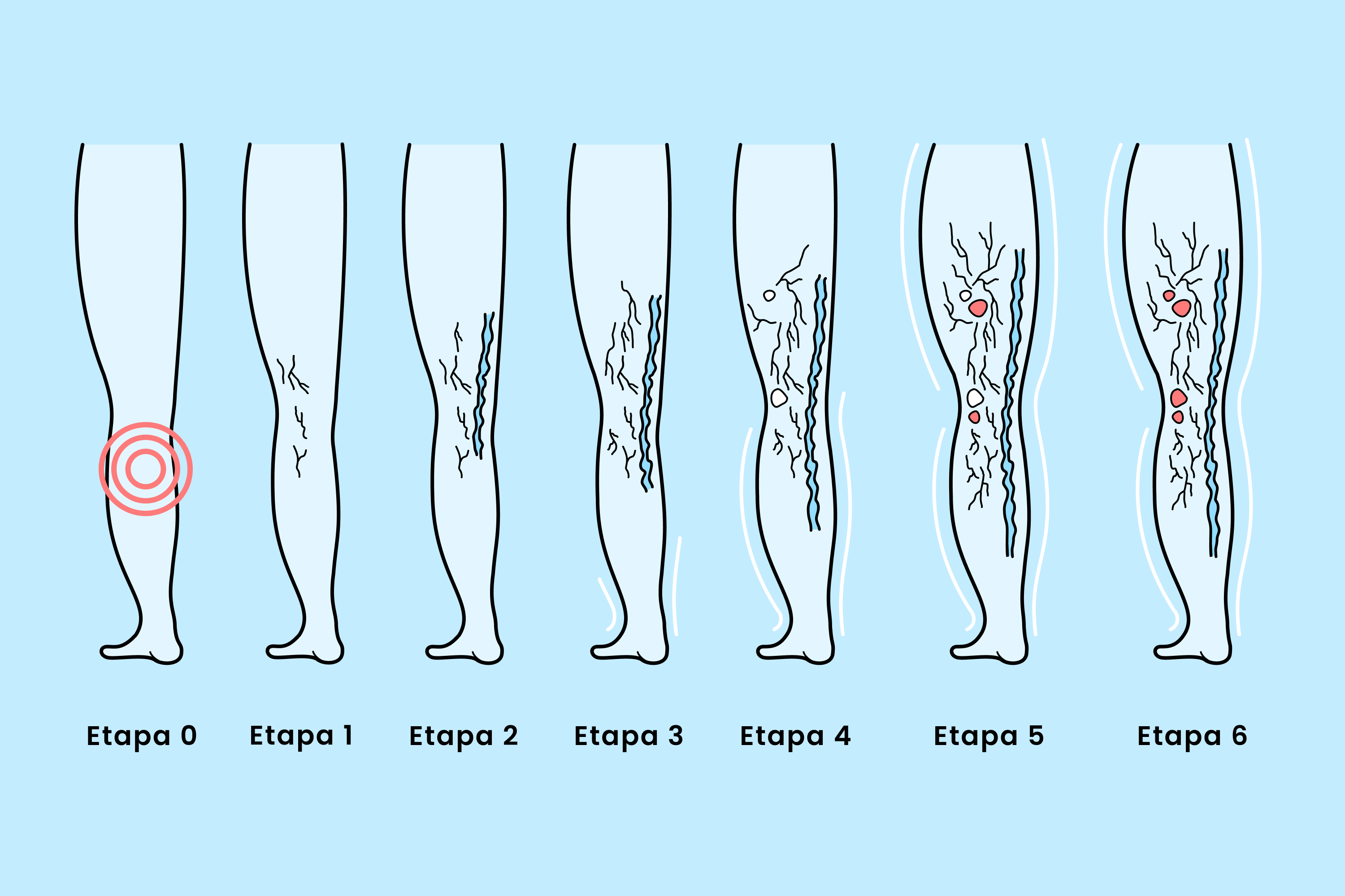 Conozca las etapas cl&iacute;nicas de las venas varicosas, desde las ara&ntilde;as vasculares tempranas hasta las &uacute;lceras venosas avanzadas, adem&aacute;s de las opciones de tratamiento para cada etapa y las estrategias de prevenci&oacute;n para unas piernas m&aacute;s saludables.