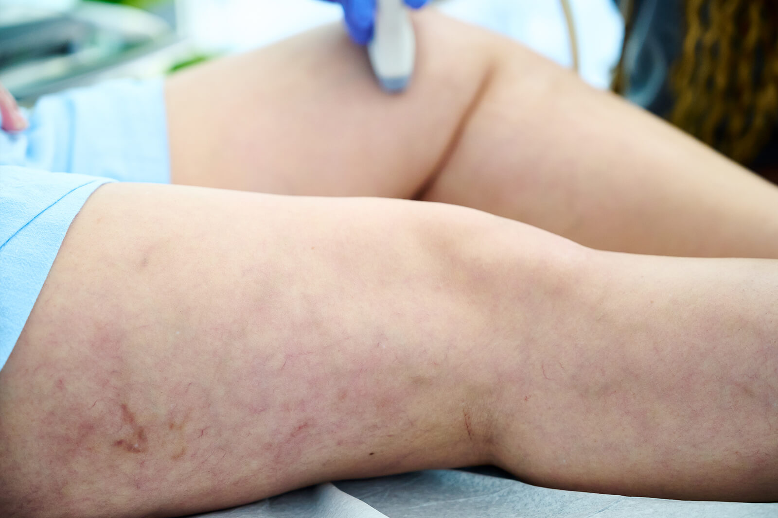 Descubre c&oacute;mo ofrece la Escala de Gravedad Cl&iacute;nica Venosa (VCSS) a los especialistas en venas una herramienta din&aacute;mica y detallada para evaluar la gravedad de la enfermedad venosa cr&oacute;nica, orientar el tratamiento y monitorear el progreso del paciente a lo largo del tiempo.